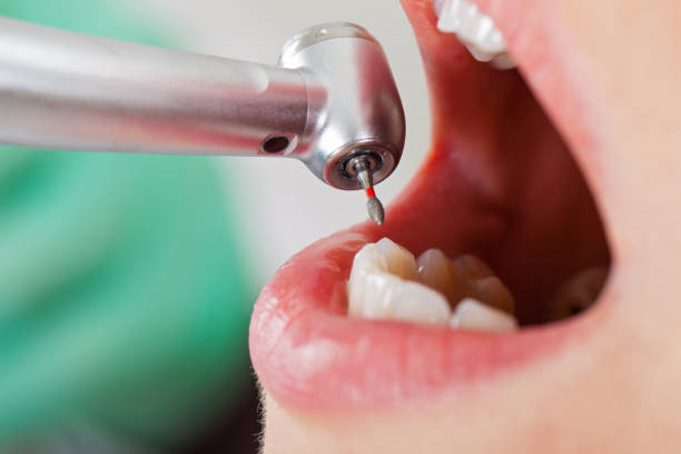 Best Emergency Dental Care for Abscessed Tooth in Laymantown, VA